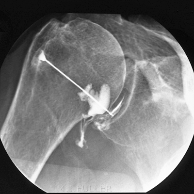 shoulder arthrogram needle insitu