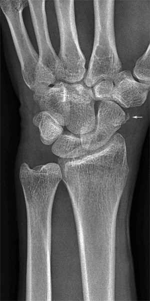 scaphoid fracture obl