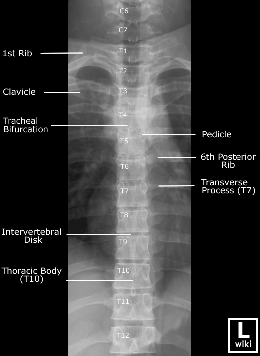Radiographic Anatomy - Thoracic Spine AP