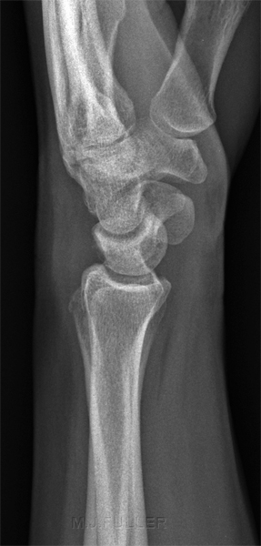 LATERAL WRIST