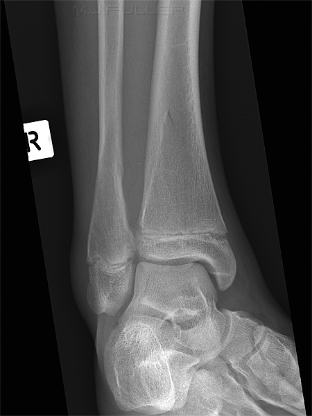 ankle trauma 1 obl