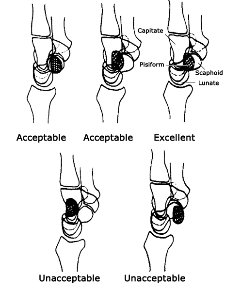 Lateral wrist acceptability graphic