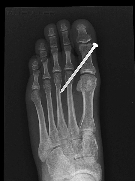 nail in foot