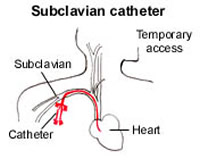 vascath - sublavian insertion