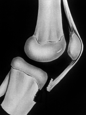 tibial tuberosity fracture type II