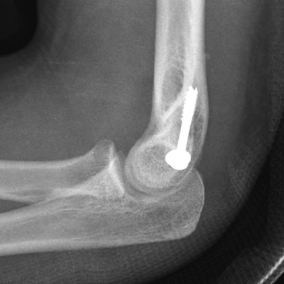 medial epicondyle fracture post fixation