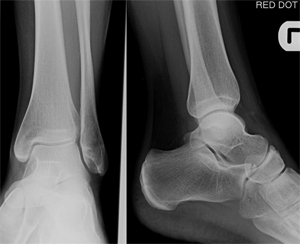 ankle X-ray
