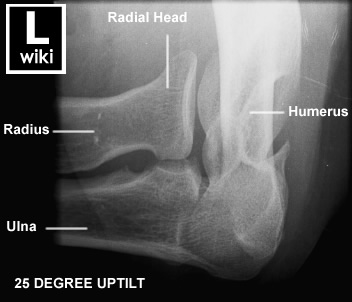 Radiographic Antomy - Elbow Radial Head