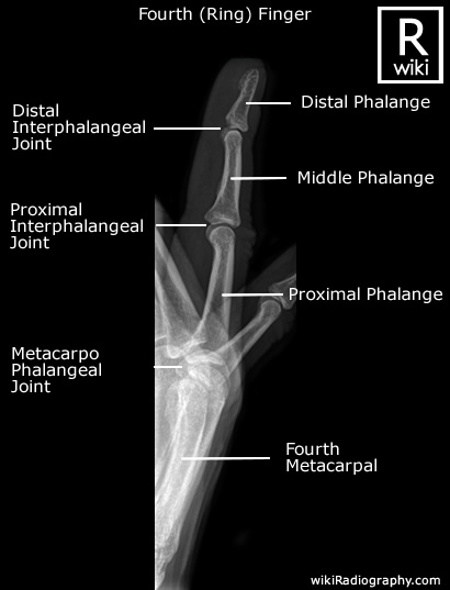Fourth (Ring) Finger - Lateral - Radiographic Anatomy