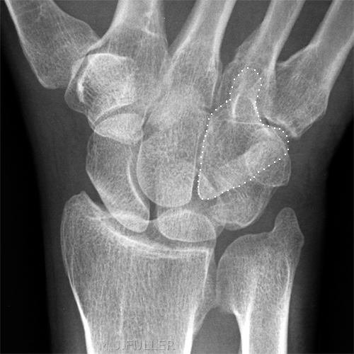 HAMATE FRACTURE scaphoid view