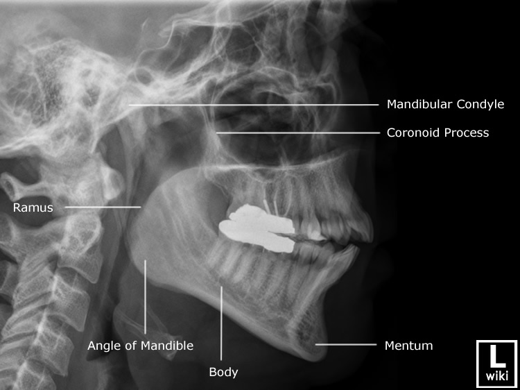 Radiographic Anatomy - Mandible Lateral