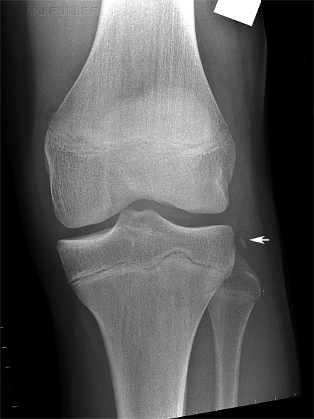 Segond Fracture Wikiradiography