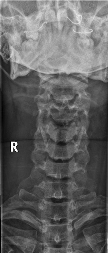 AP cervical spine