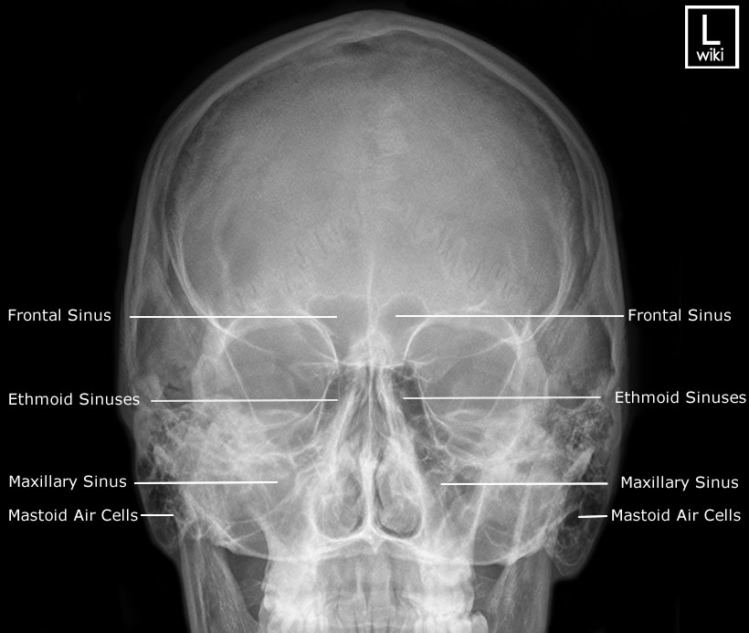 Radiographic Anatomy - Sinuses - PA 15 Caldwell