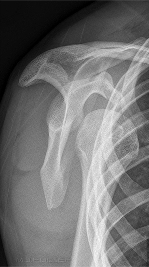 lateral scapula