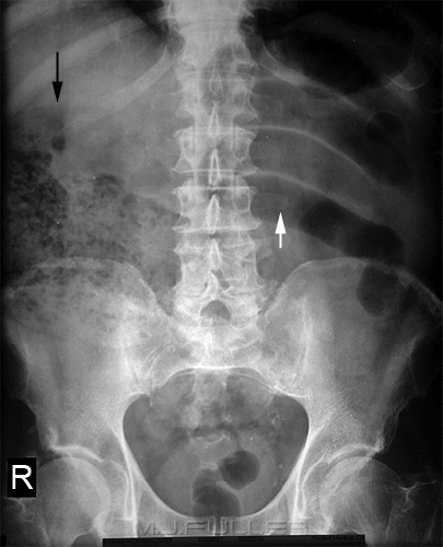 Small Bowel Obstruction - wikiRadiography