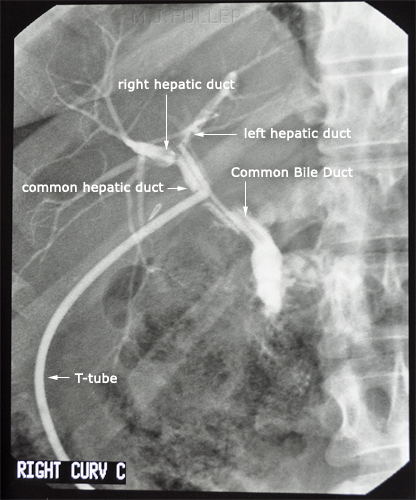 T-tube Cholangiogram