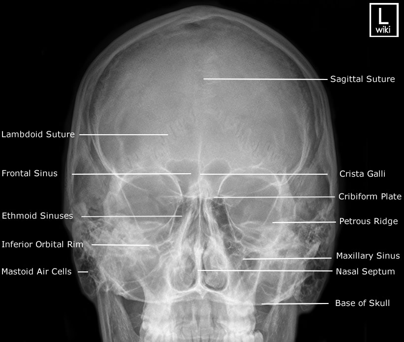 Radiographic Anatomy - PA Caldwell