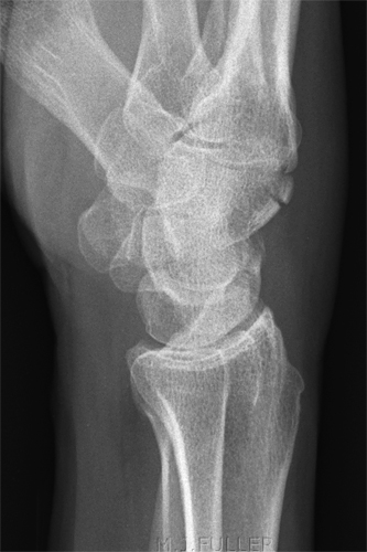 HAMATE FRACTURE lat