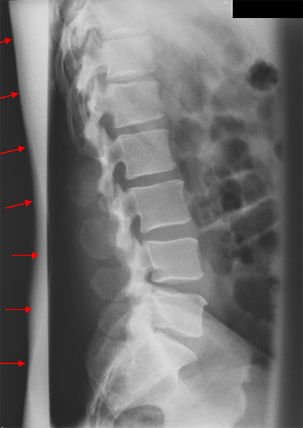 lateral lumbar spine collimation