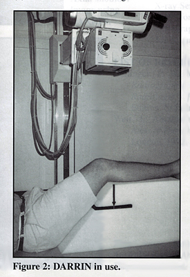 Supine Intercondylar Knee Radiography - wikiRadiography