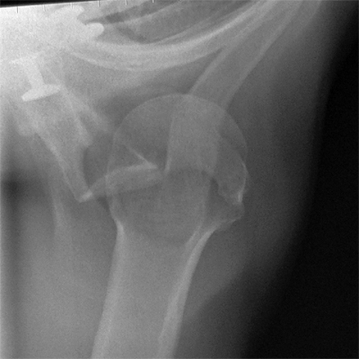 SI shoulder- inferior dislocation