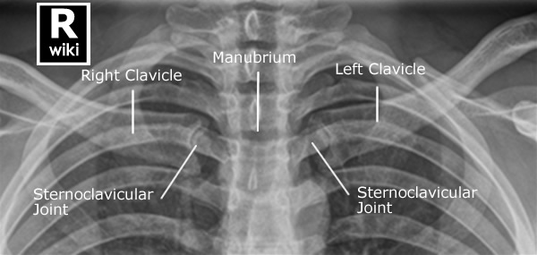Radiographic Anatomy - Sternoclavicular Joints PA Both