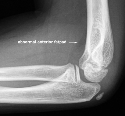 abnormal anterior elbow fatpad