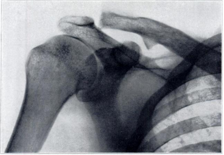 R Coracoclavicular joint