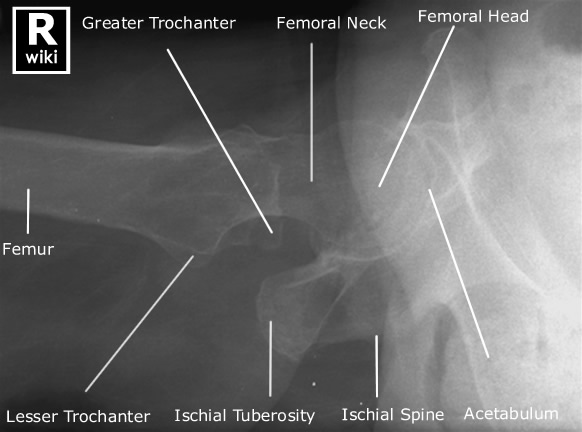 Radiographic Anatomy - Hip - Horizontal Ray