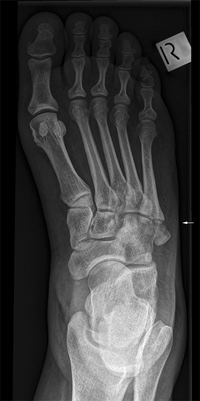 5th metatarsal fracture
