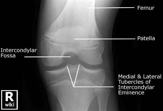 Radiographic Anatomy - Knee -Intercondylar