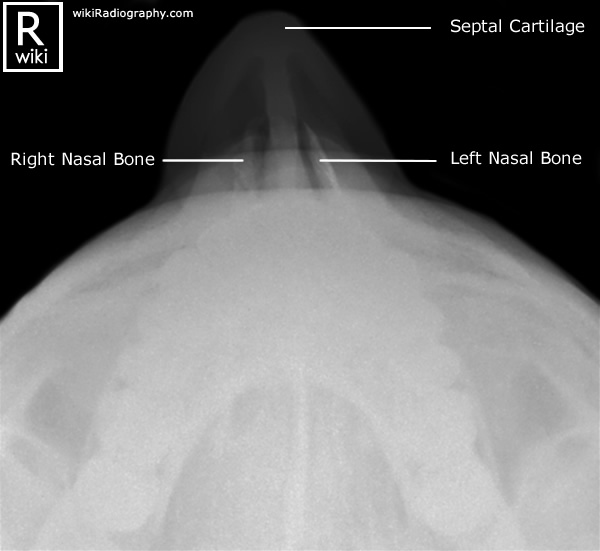 Nasal Bones - Superoinferior (Axial) - Radiographic Anatomy