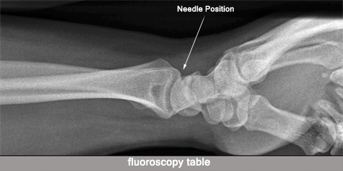 wrist arthrography needle position