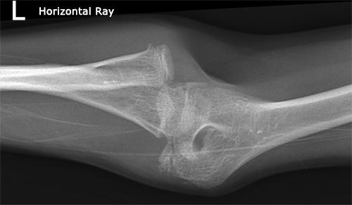 Imaging Radial Head Fractures - wikiRadiography