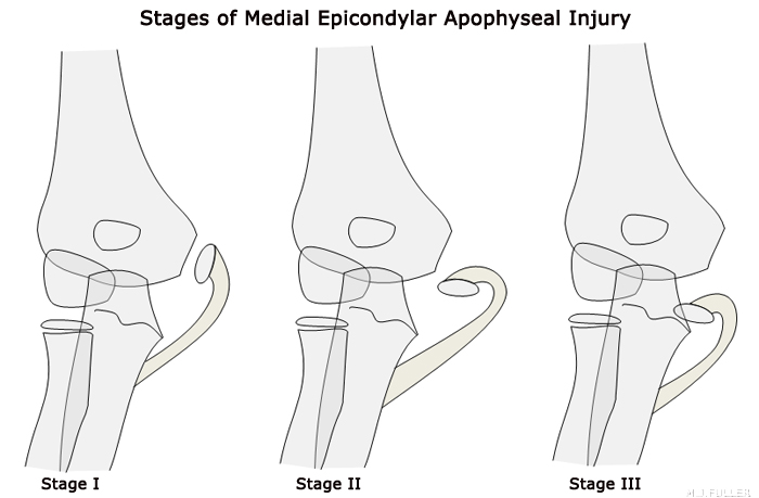 medial epicondyle fracture staging