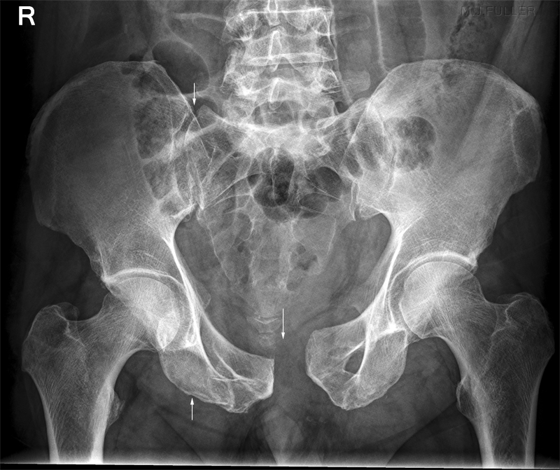 What are open book pelvic fractures?