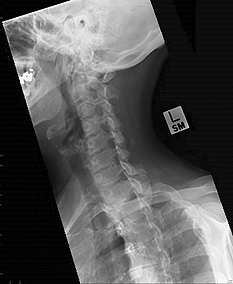 left oblique c spine