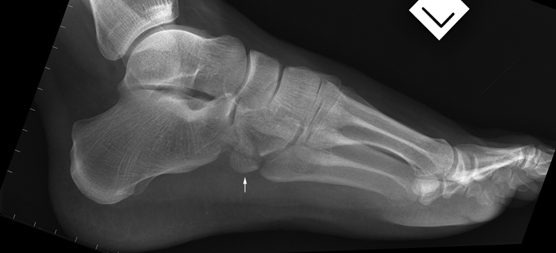 Lateral foot