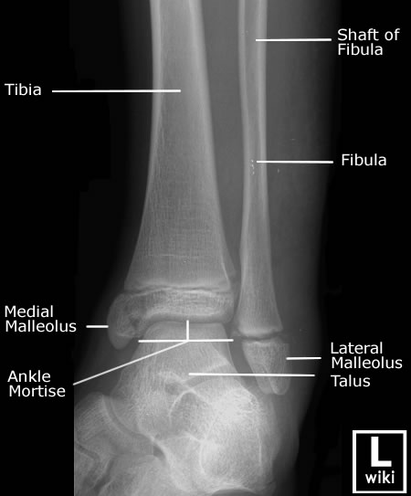Radiographic Anatomy - Ankle - Mortise