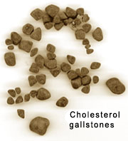 cholesterol gallstones