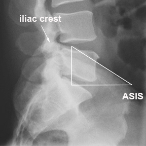 lateral lumbosacral junction