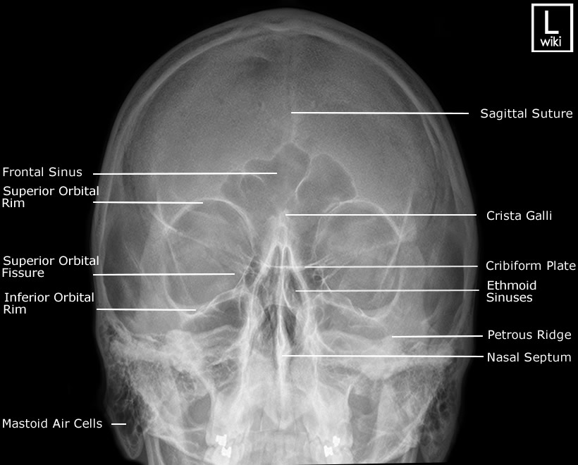 Facial Bones - PA 30° (Caldwell)