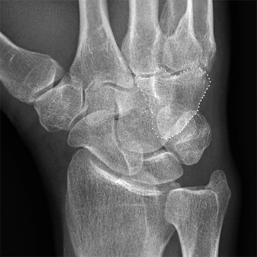 HAMATE FRACTURE obl