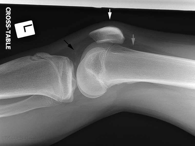 knee trauma 1 lateral knee answer