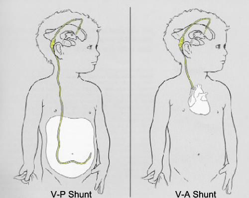 VP and VA shunts