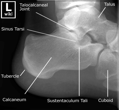 Radiographic Anatomy - Calcaneum Lateral