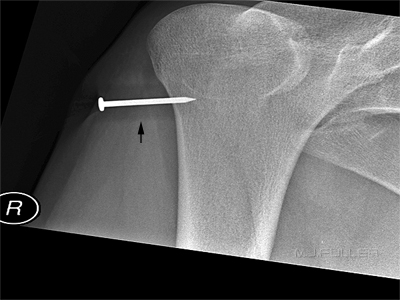 nail gun injury knee