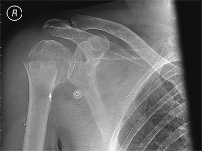 shoulder fracture-dislocation