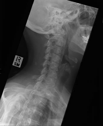 Cervical Spine Oblique - Markers - wikiRadiography